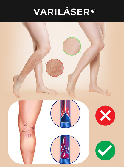 VARILÁSER ®